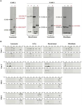 FXS-Like Phenotype in Two Unrelated Patients Carrying a Methylated Premutation of the FMR1 Gene